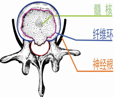 人体腰椎管狭窄示意图图片